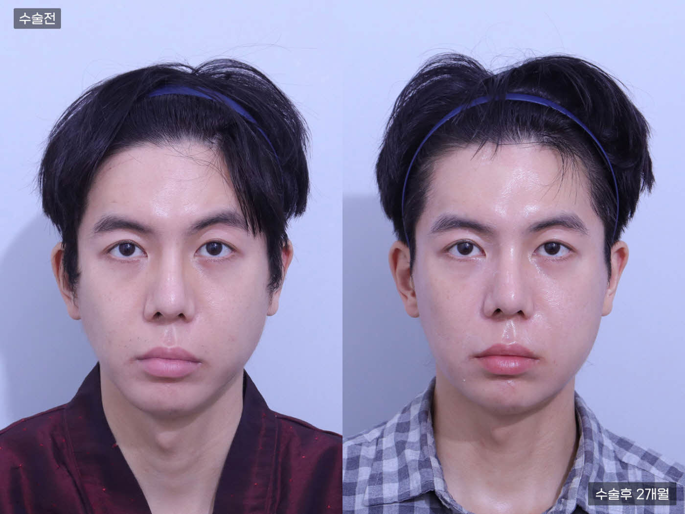 사각턱