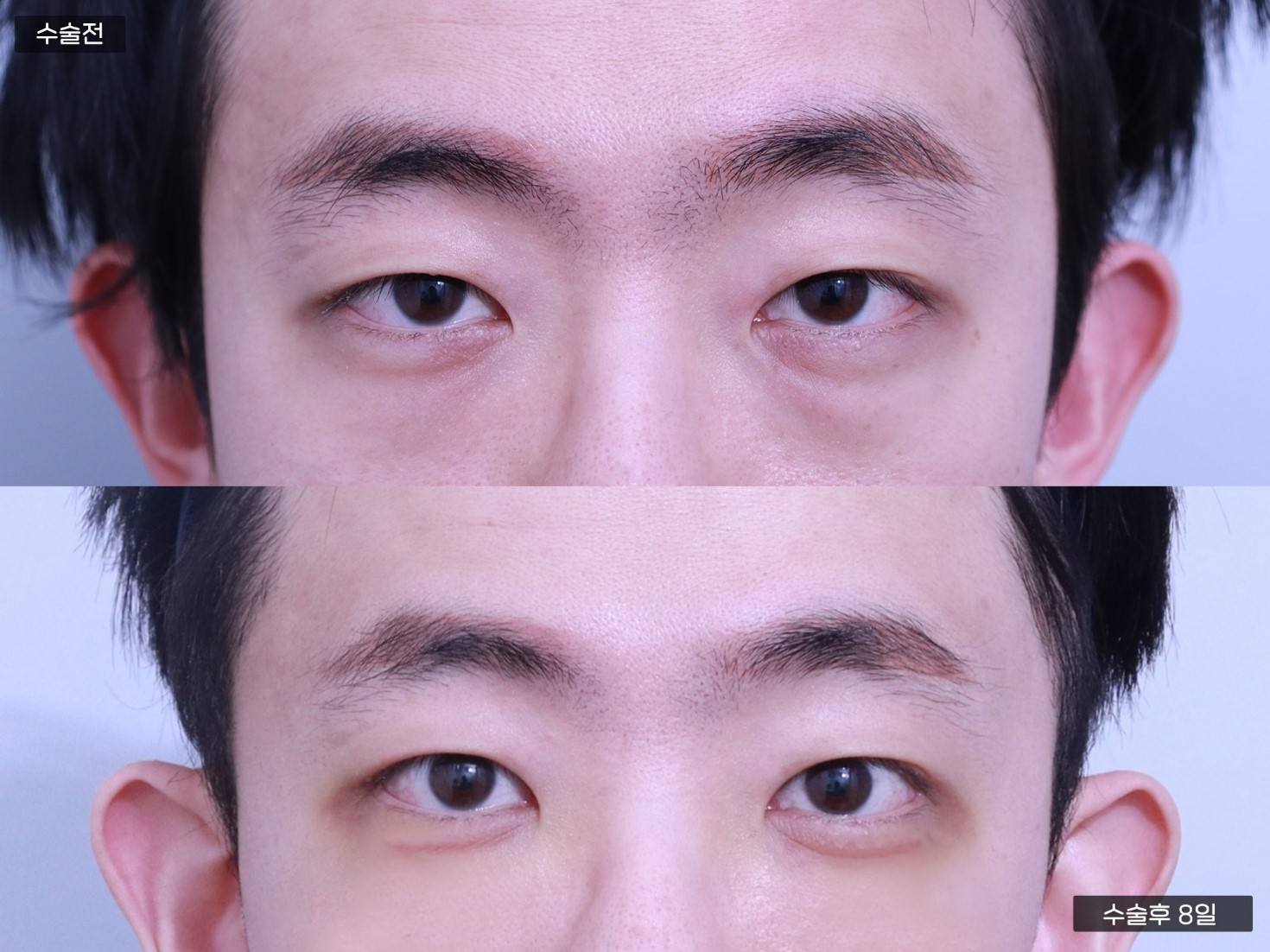 눈밑지방재배치