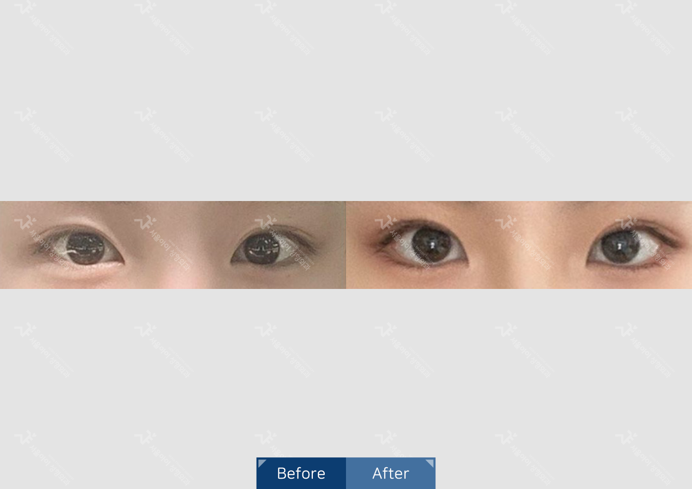 눈성형 [자연유착 쌍꺼풀 + 앞트임]