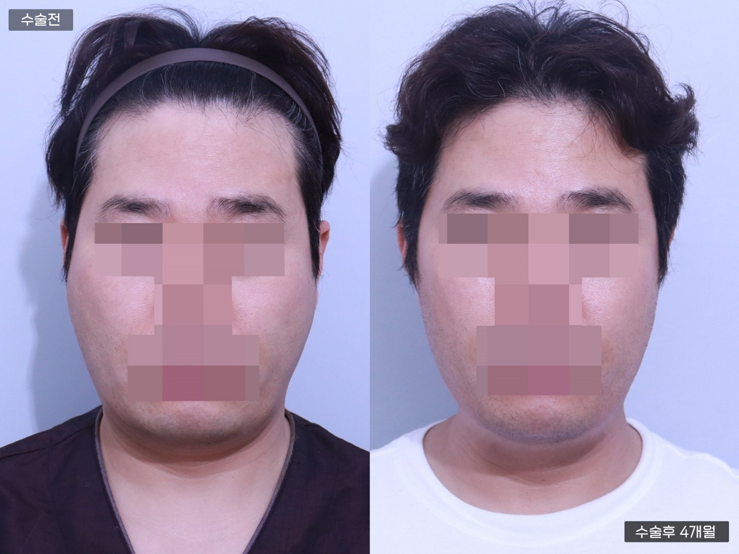 얼굴지방흡입 [이중턱, 옆볼, 목, 턱선]