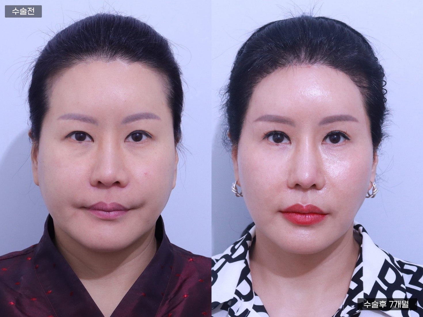 모발이식[절개 모발이식(3000모)]