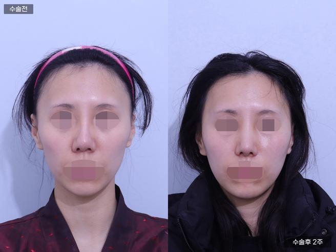 안심 코 재수술