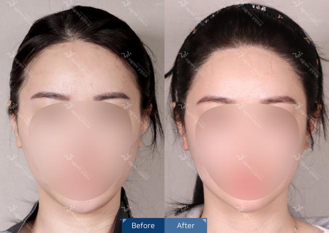 Non-incisional hair transplantation