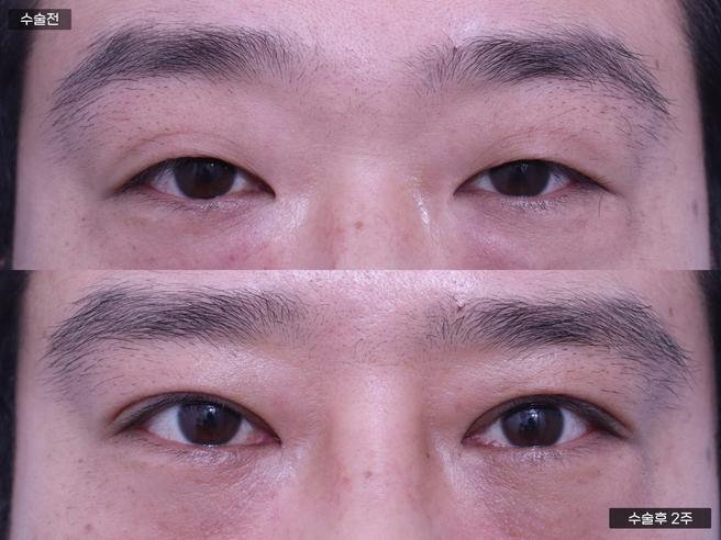 절개쌍꺼풀