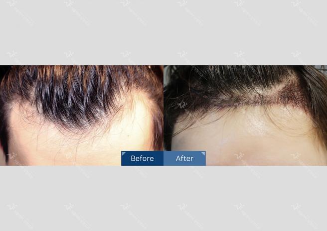 Seoul i Hair Transplant