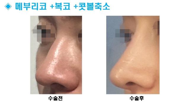 남자코성형