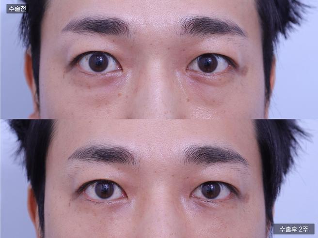 눈성형 [눈밑지방재배치]
