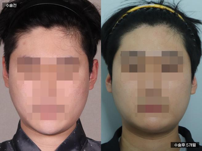 Non-incisional hair transplantation