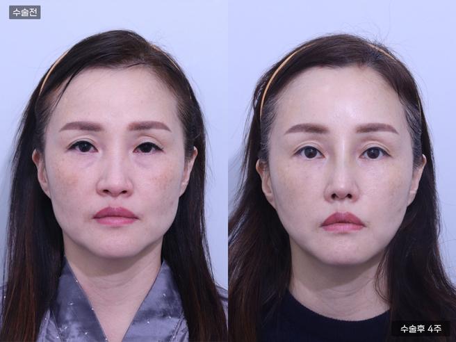 엘라스티꿈 실리프팅
