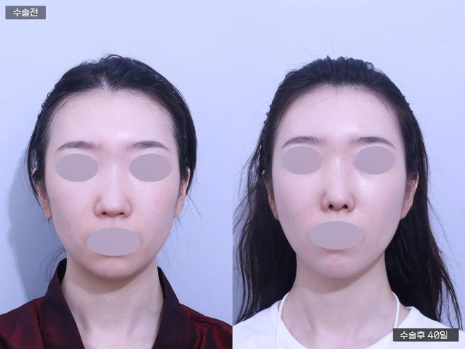 안심 코 재수술