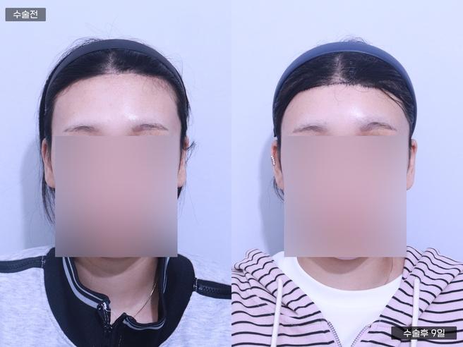額頭縮小