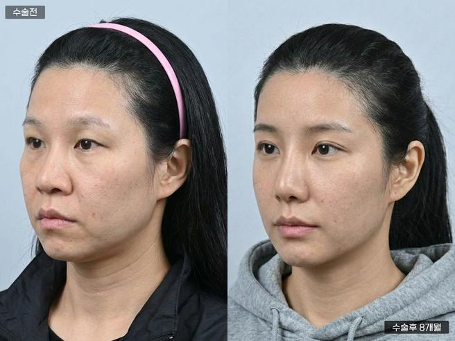 실루엣소프트 실리프팅