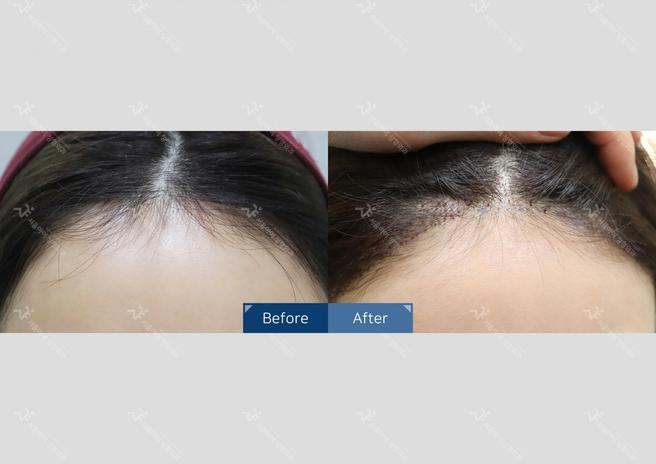 Seoul i Hair Transplant