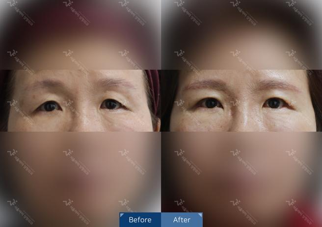 눈썹거상술