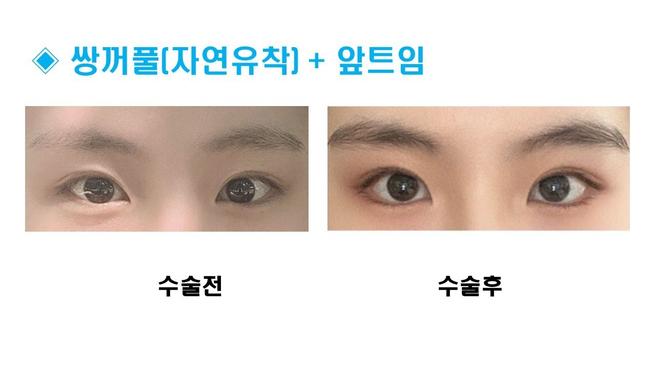 자연유착 쌍꺼풀