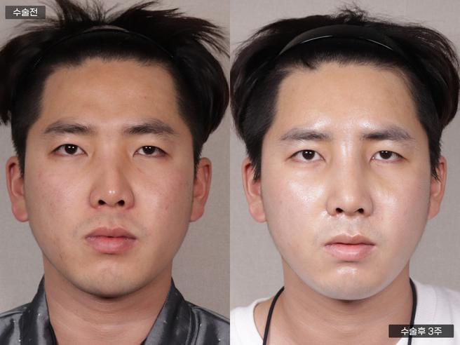 PRP 풀페이스지방이식