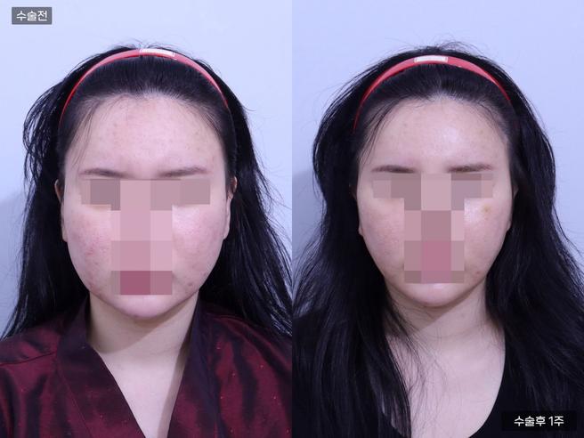 콘셀티나 실리프팅