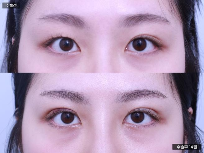 자연유착 쌍꺼풀