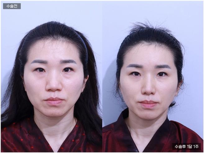 풀페이스 지방이식 + 복코교정 + 매부리코교정
