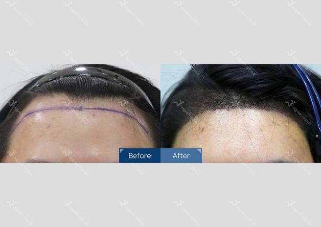 Seoul i Hair Transplant