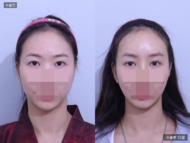 엘라스티꿈 실리프팅