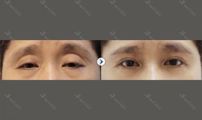 눈썹거상술