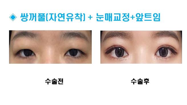자연유착 쌍꺼풀
