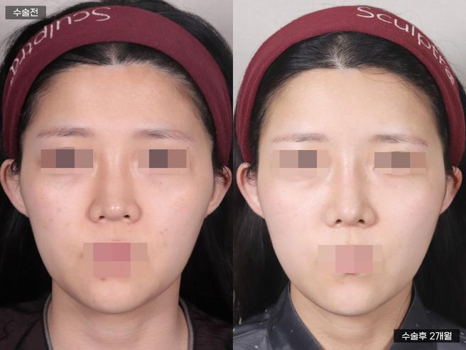 PRP 풀페이스지방이식