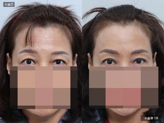 엘라스티꿈 실리프팅