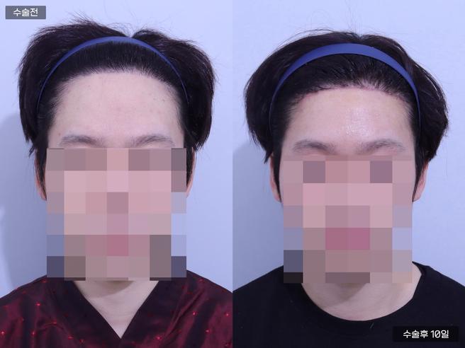 額頭縮小