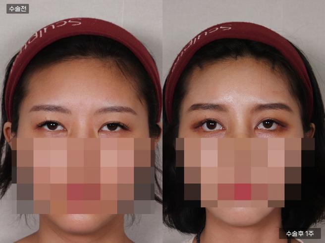 엘라스티꿈 실리프팅