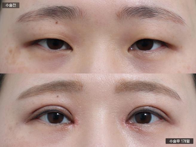 절개쌍꺼풀