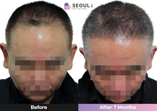 Non-incisional hair transplantation