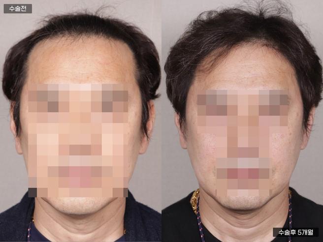 Non-incisional hair transplantation