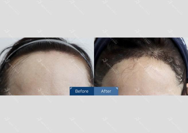 Seoul i Hair Transplant