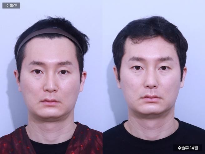 코끝교정 + 휜코 + 매부리코
