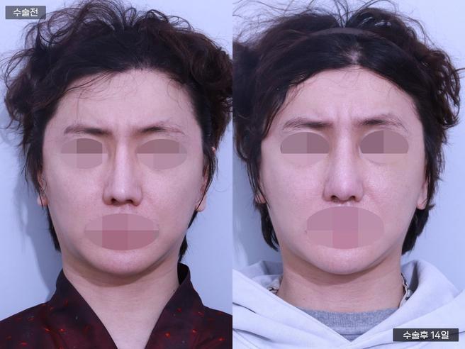 안심 코 재수술