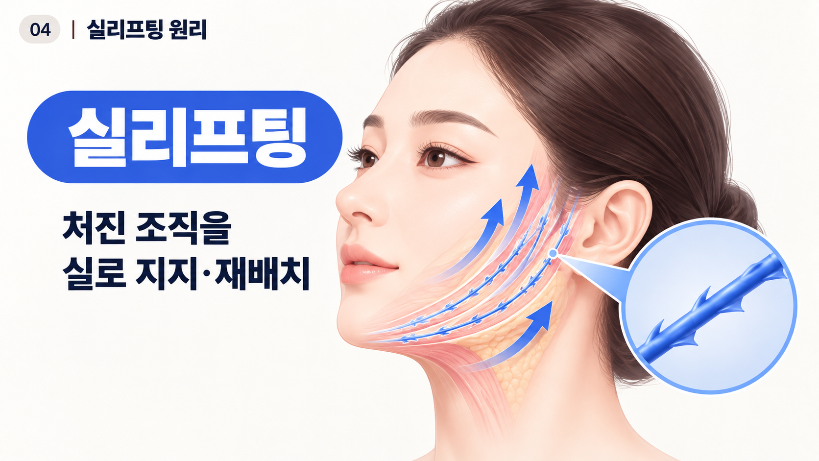 실리프팅 처진 볼과 턱선 조직 리프팅 원리
