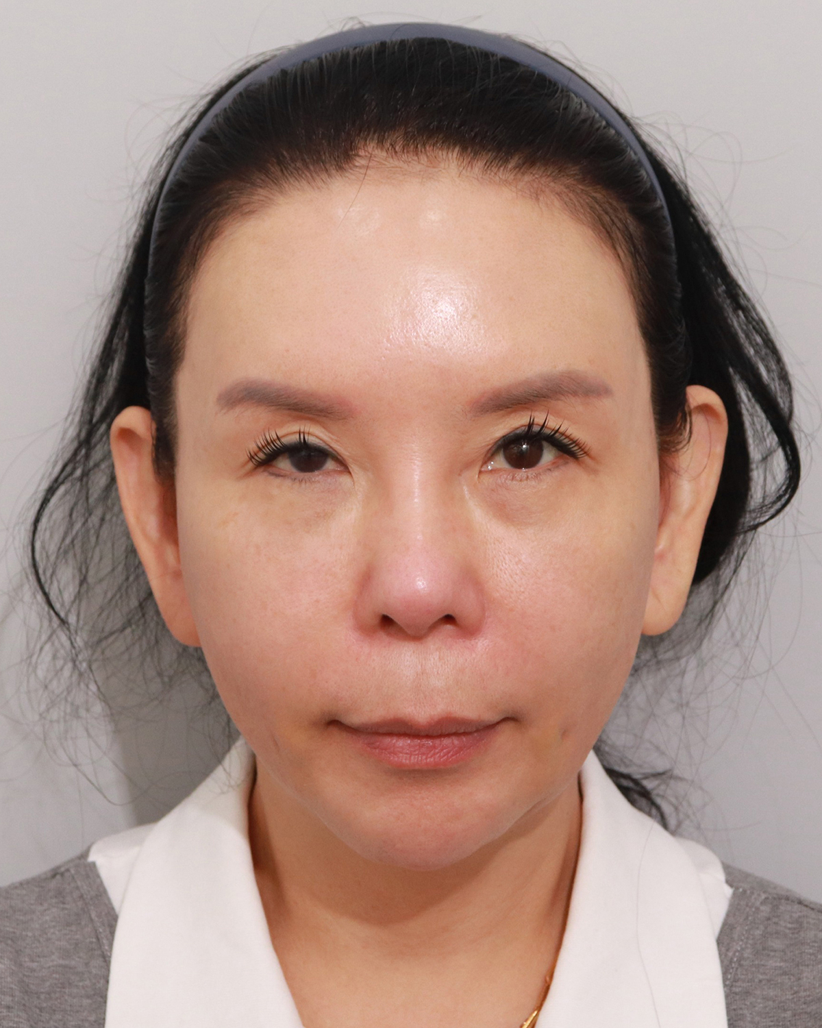 레디어스와 실리프팅 병행 시술 후 모델 사진