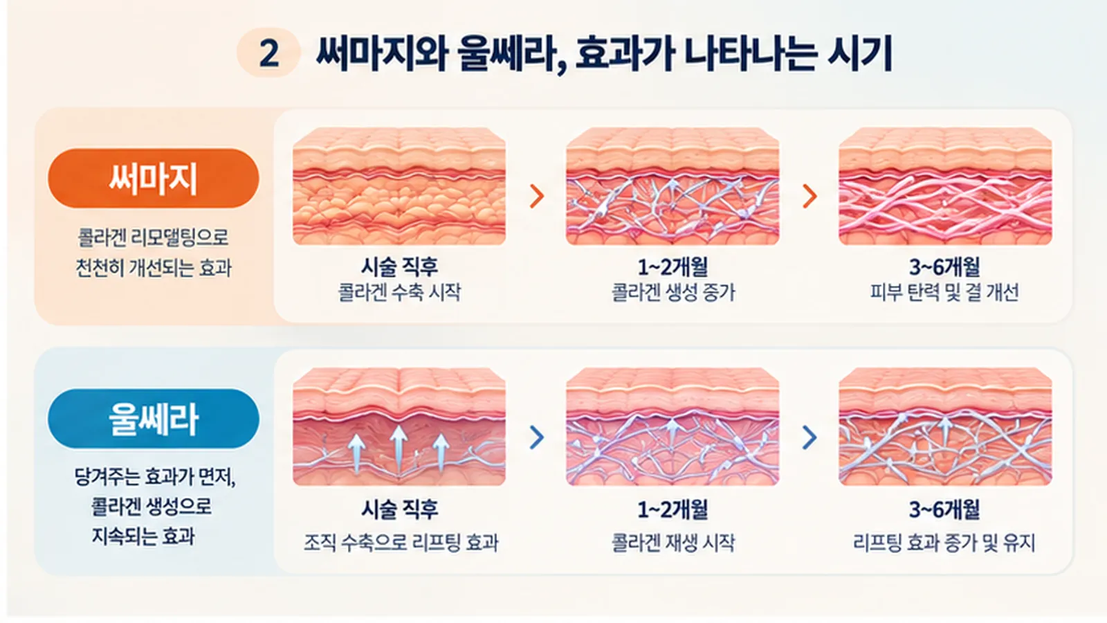 써마지 울쎄라 효과 나타나는 시기 유지기간 콜라겐 변화 타임라인