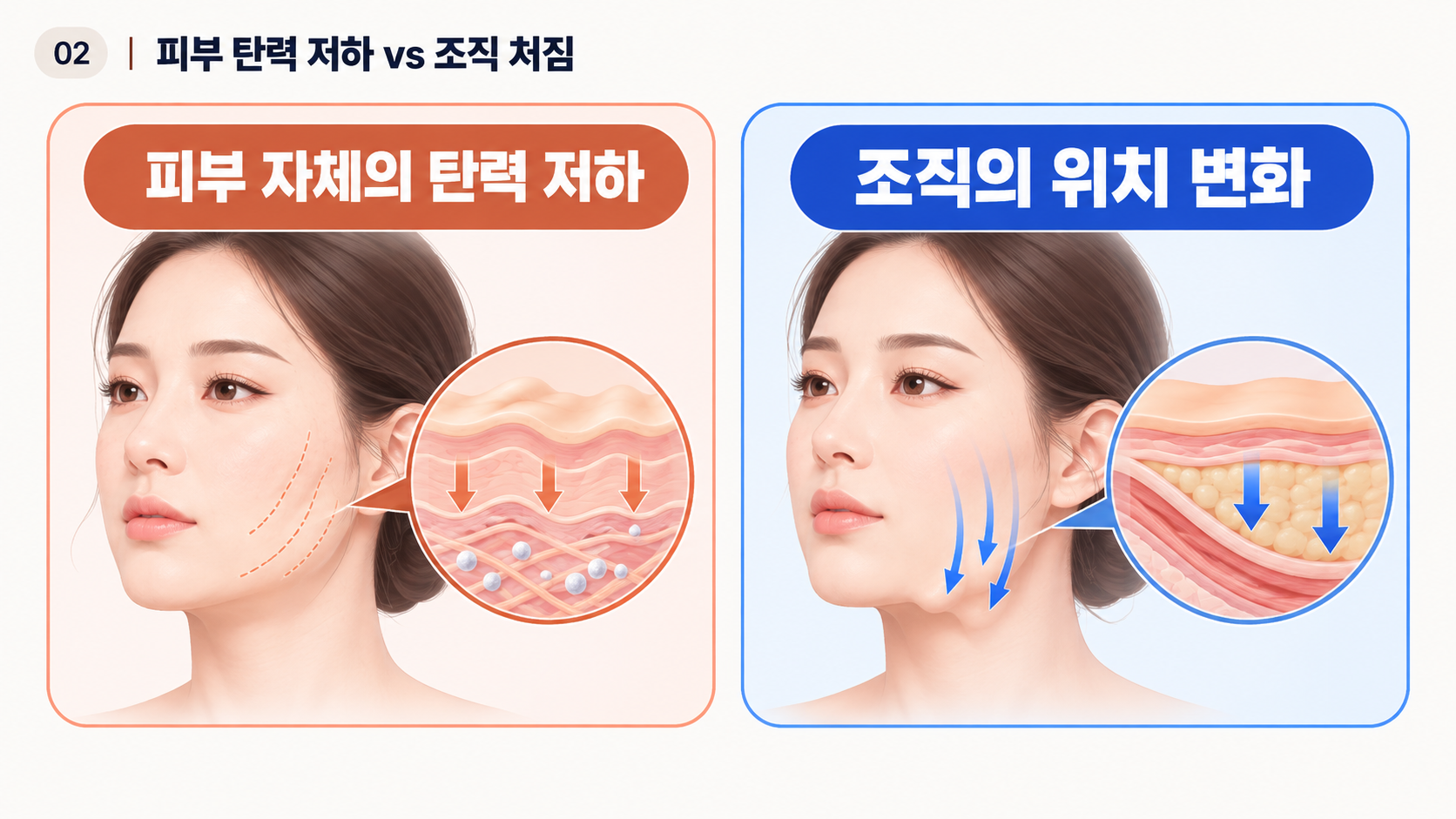 레디어스 실리프팅 피부 탄력 저하와 얼굴 처짐 차이