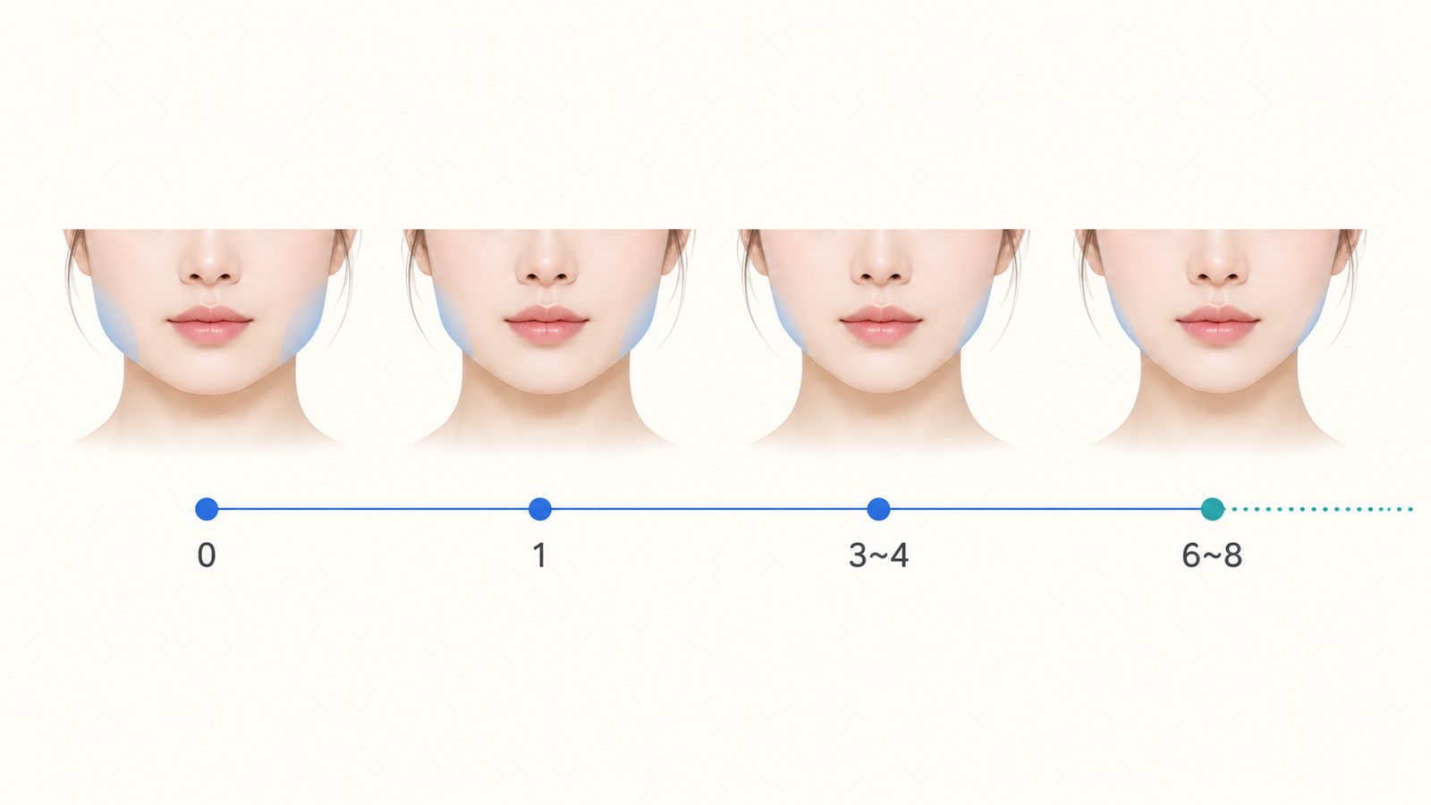 사각턱 보톡스 주기 타임라인, 0·1·3~4·6~8개월 시점과 이후 유지기