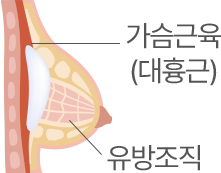 근육 위 삽입 단면도