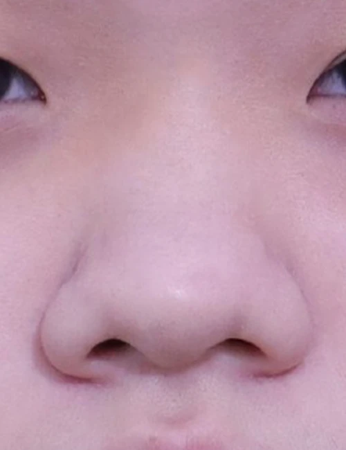 맞춤 코성형 수술 전