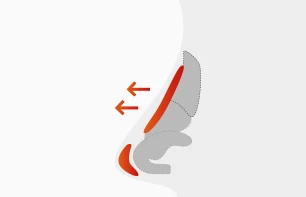 수술 진행 일러스트