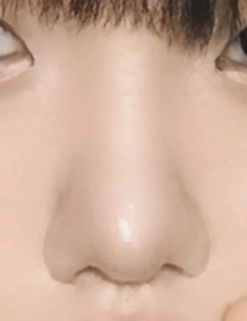 맞춤 코성형 수술 후