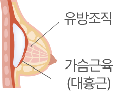 근육 밑 삽입 단면도