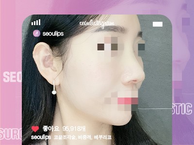 리얼셀카_#코끝조각술 #비중격 #메부리코