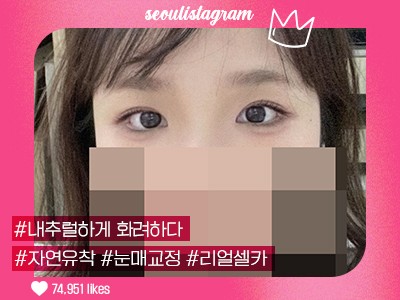 #자연유착 #눈매교정 #앞트임