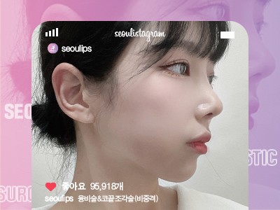 리얼셀카_#융비술&코끝조각술(비중격)
